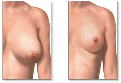 коррекция формы груди