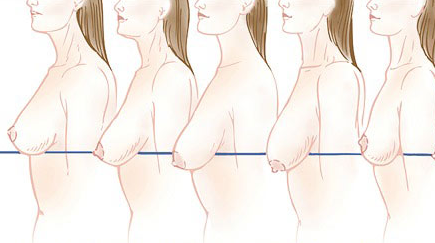 подтяжка груди после родов