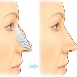 ринопластика горбинка носа